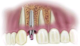 Implant Dentistry Hinsdale