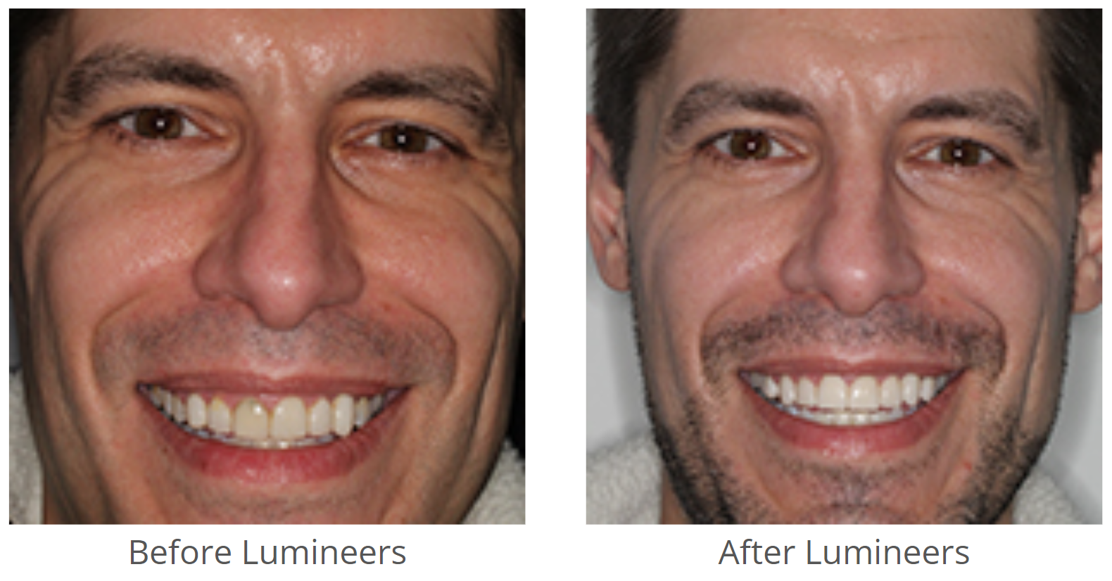 Lumineers Before And Afters From Real Patients Hinsdale Dentistry